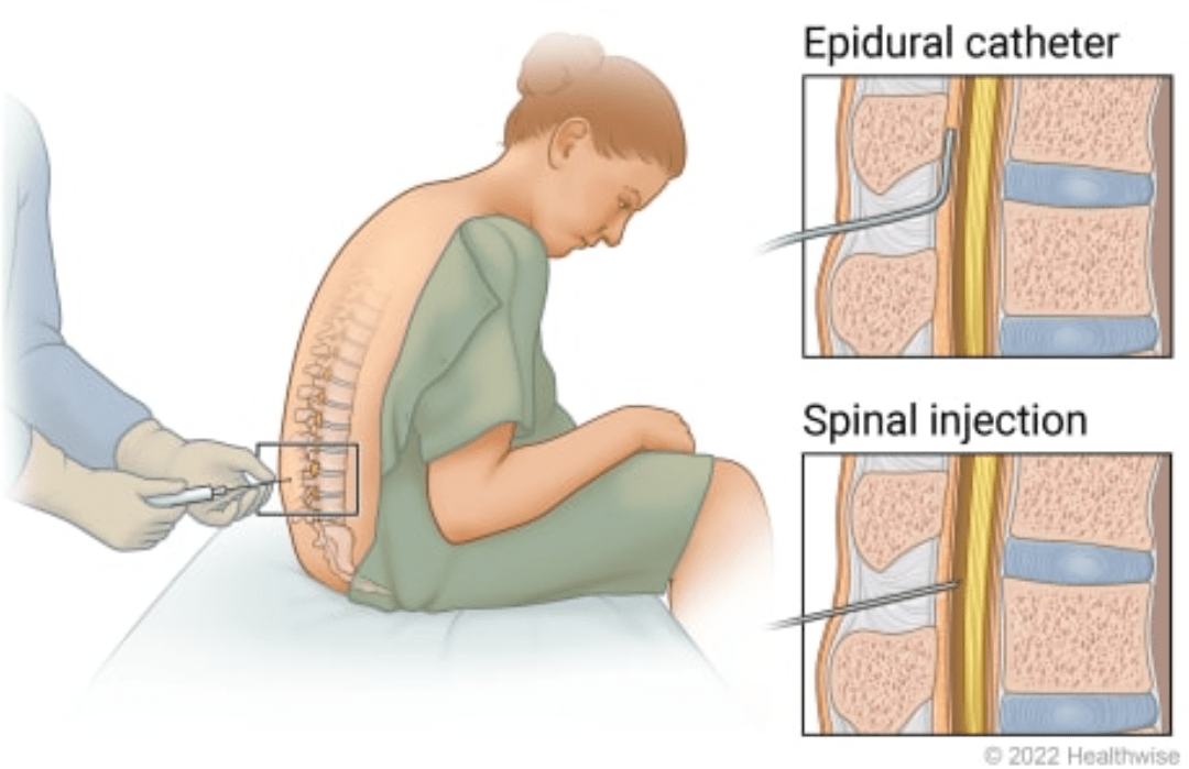 Epidural Analgesia For Labour